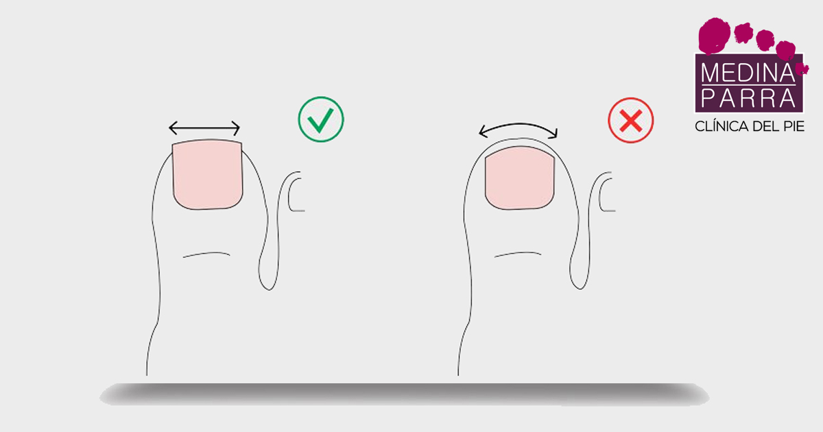Cómo deben cortarse las uñas de los pies  Clínica del pie Medina Parra