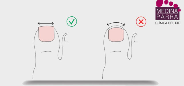 ¿Cómo deben cortarse las uñas de los pies?