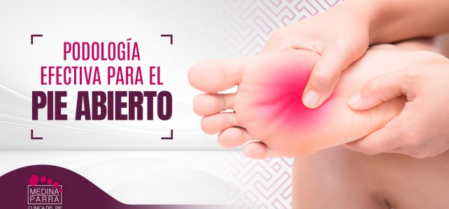 Pies abiertos: síntomas y tratamiento para tu salud podal